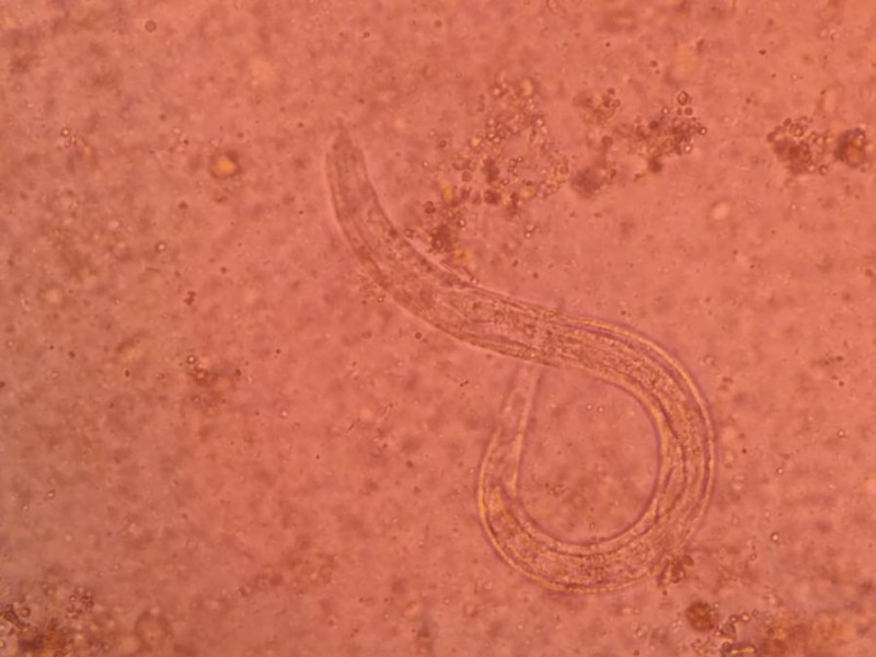 【检验临床面对面】粪便检出杆状蚴一例